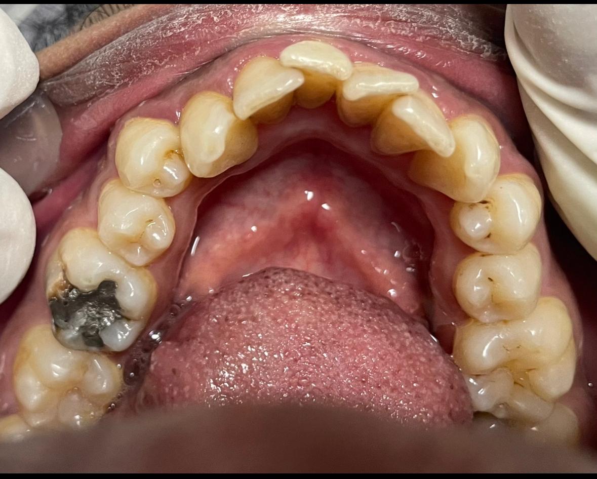 Aligner case, stage two