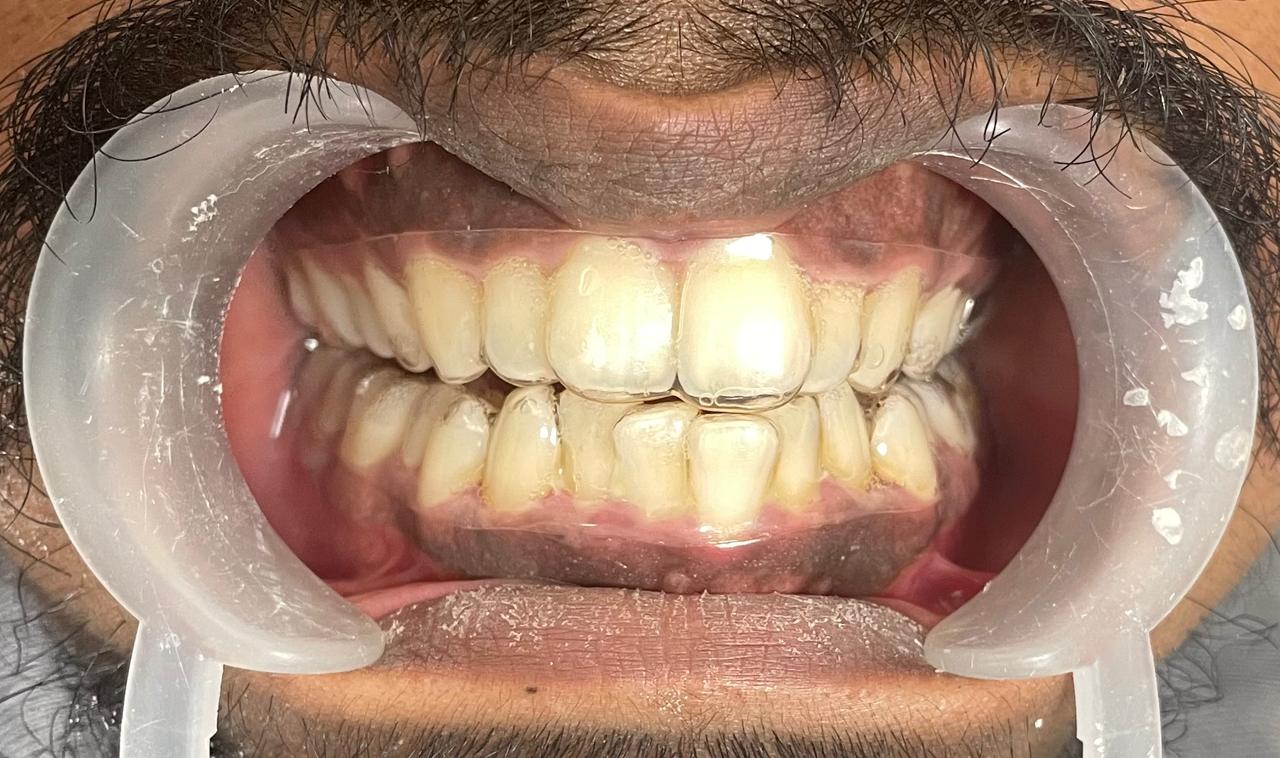 Aligner case, stage three, aligners worn in place