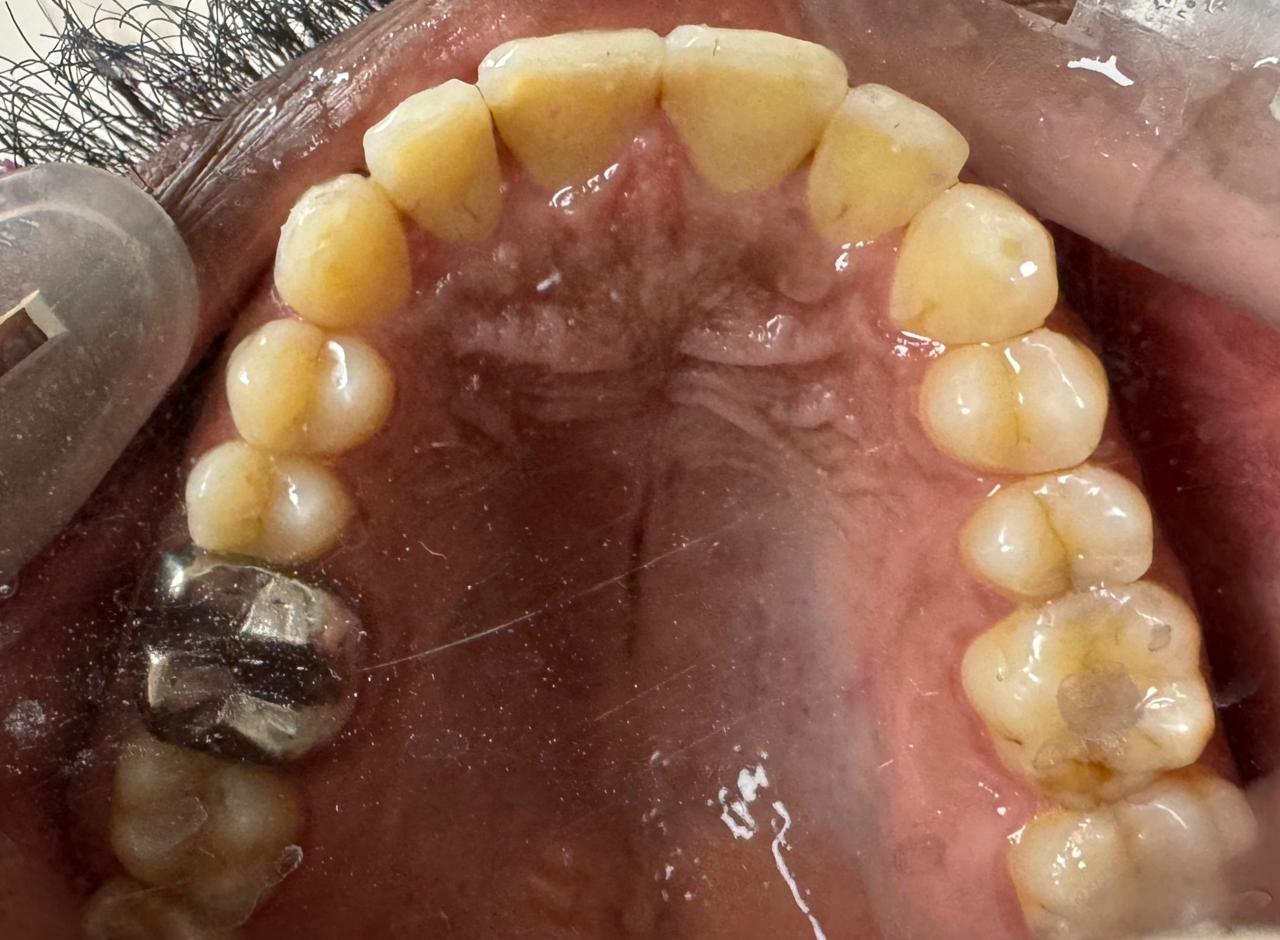 Aligner case, stage four