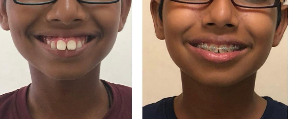 Orthodontic case, before treatment and with fixed braces in place