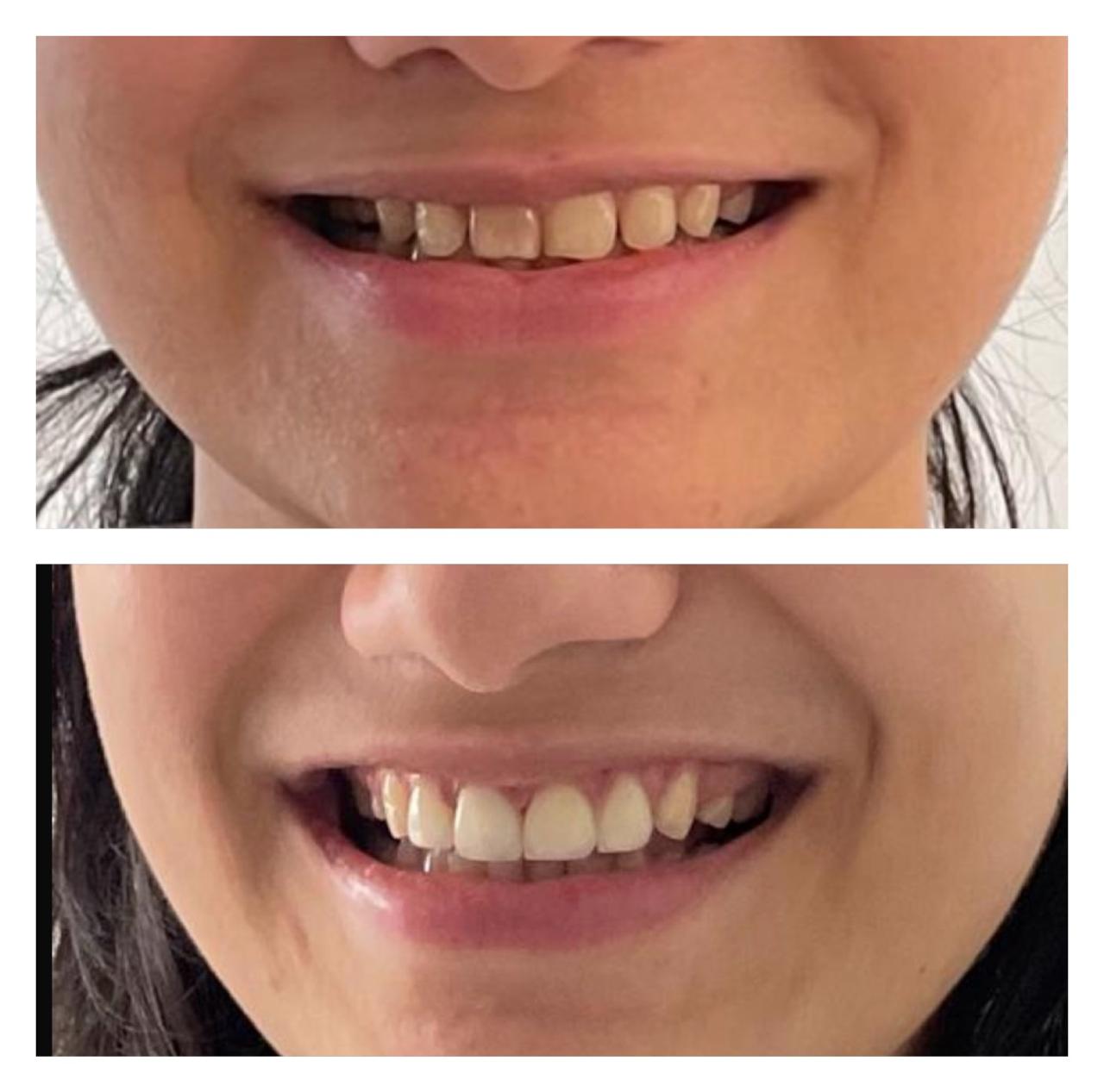 Orthodontic case, before and after treatment