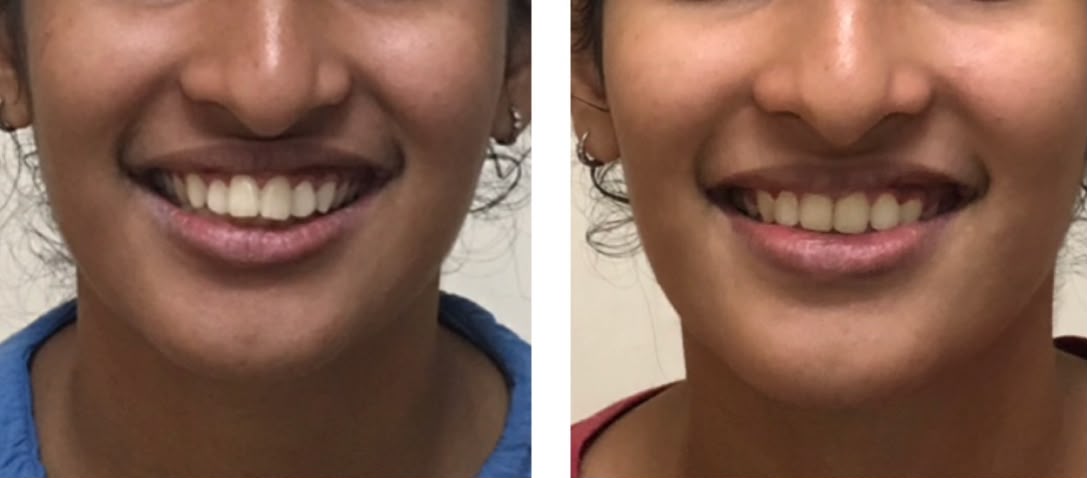Aligner case one, before and after treatment