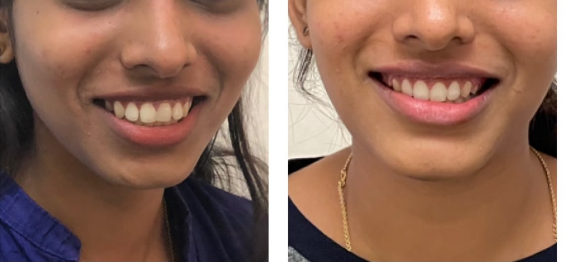 Aligner case two, before and after treatment