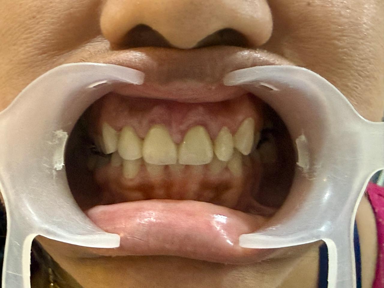 Laminate veneers in place, retracted view