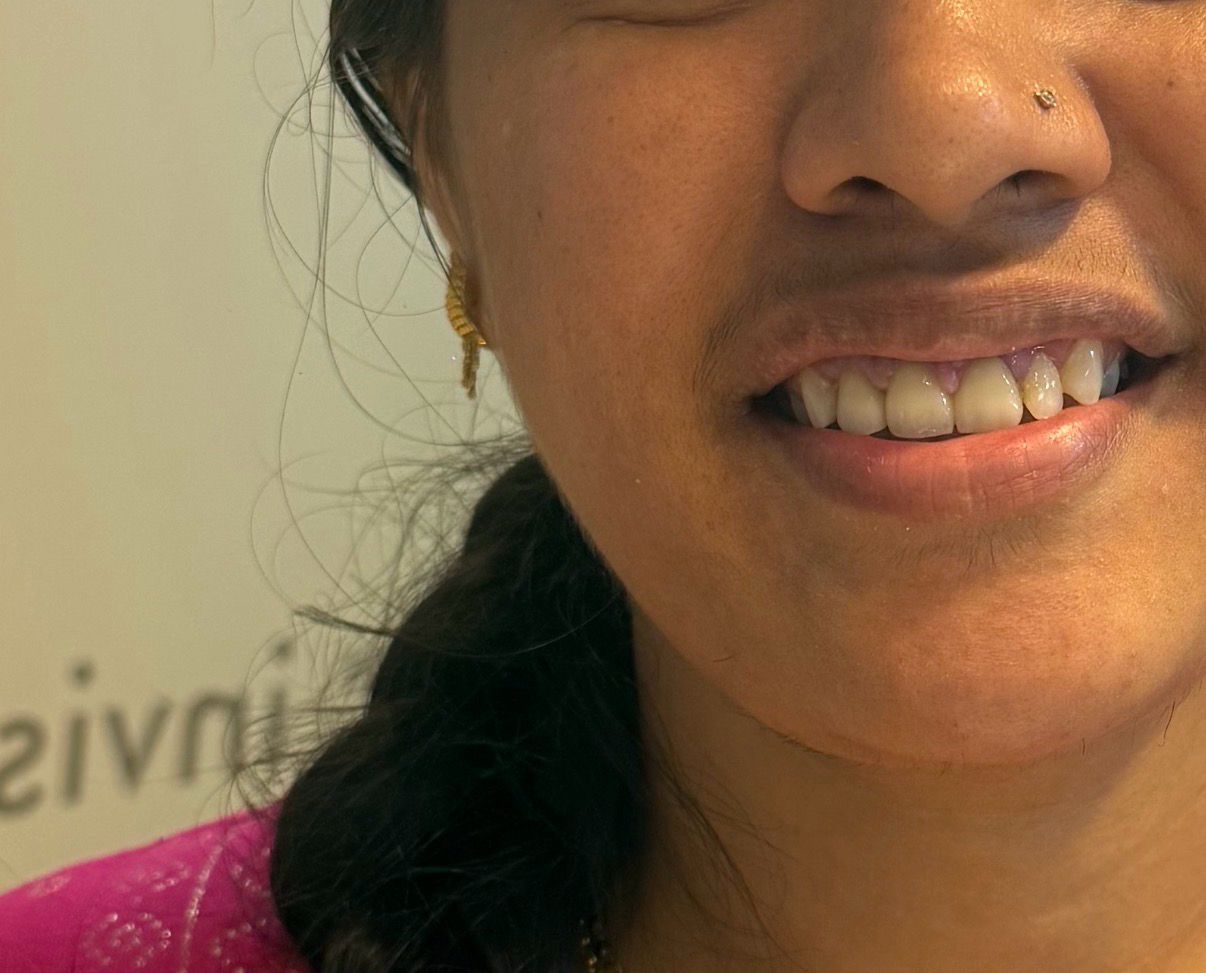 Smile after laminate veneers