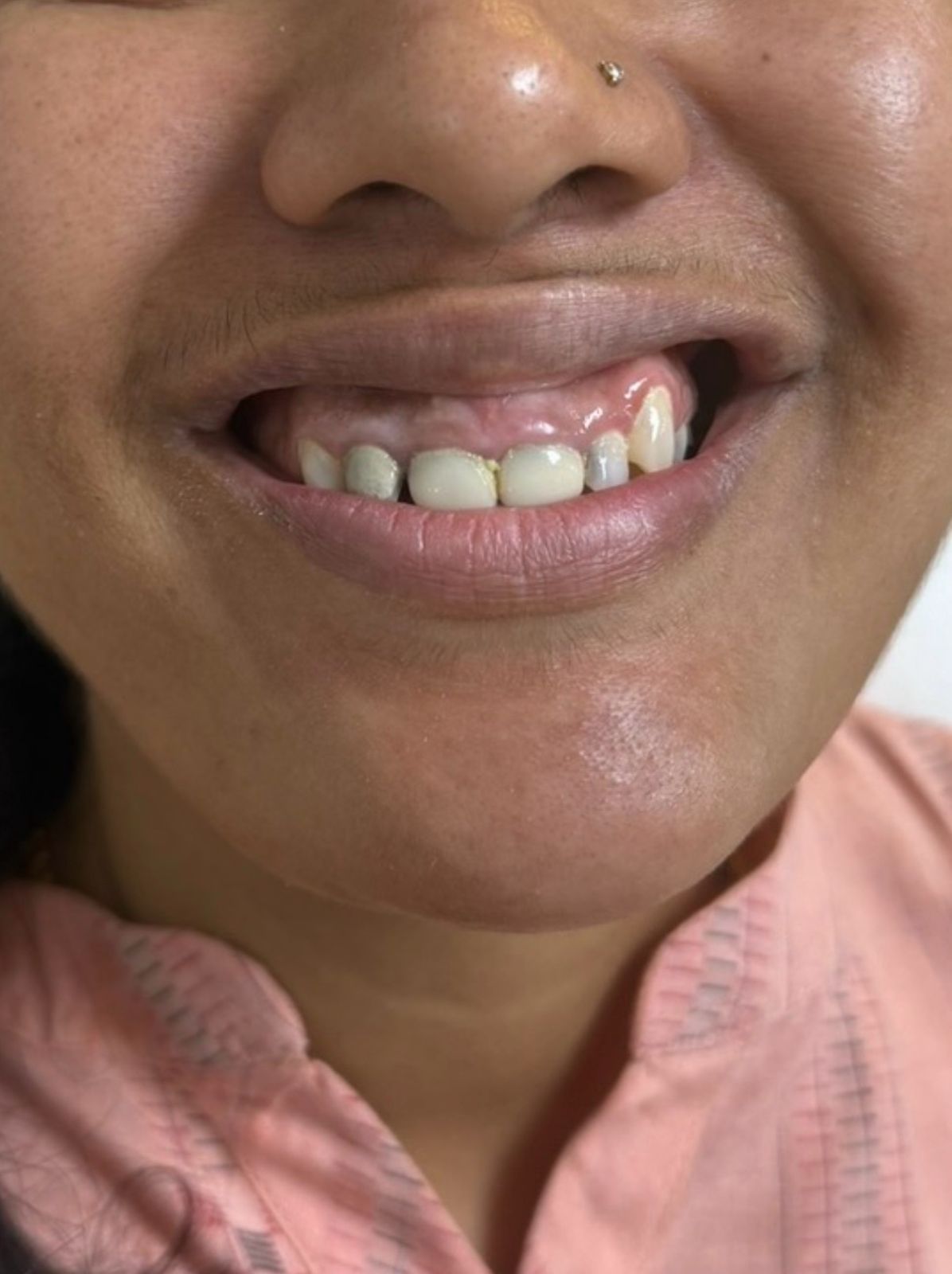 Worn and uneven upper front teeth before laminate veneers